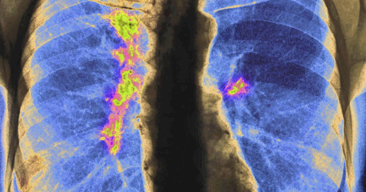Some Asian American communities experiencing high rates of certain cancers