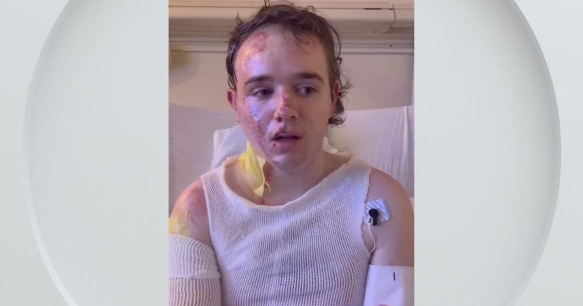 Yuba City McDonald's employee burned with hot cooking oil thanks supporters from hospital bed
