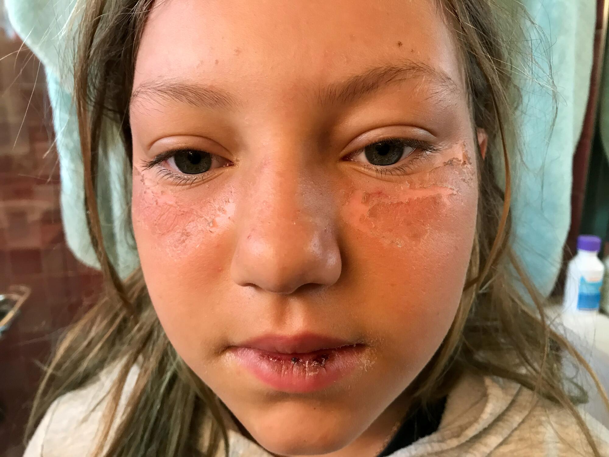 The columnist's then-10 year old niece after a bad sunburn at a beach volleyball camp in 2020.
