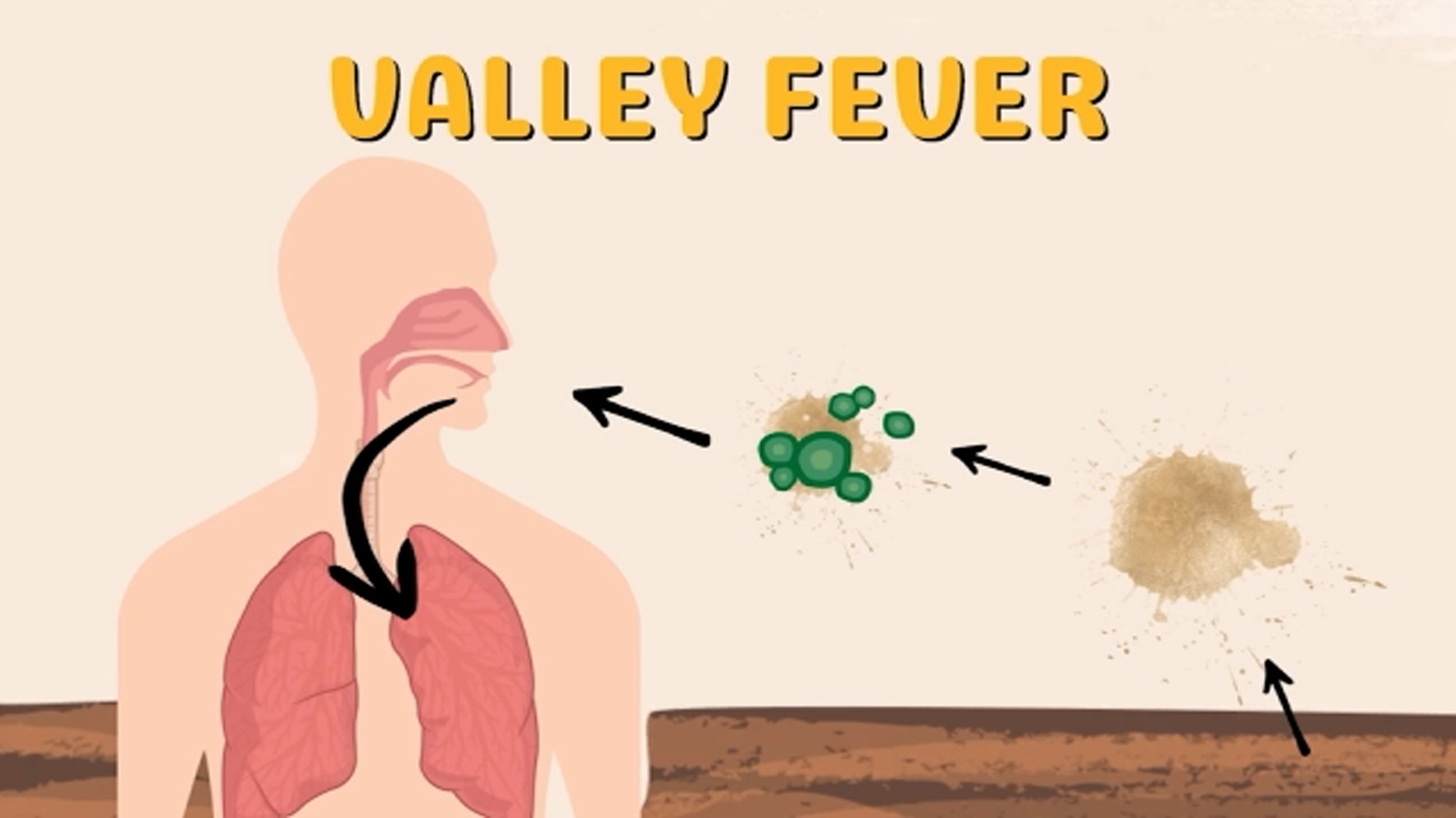 Inspire Health launches Valley Fever Care Program to expand treatment