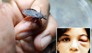 Case of deadly ‘kissing bug’ found in California — and sufferers may not even know they have it