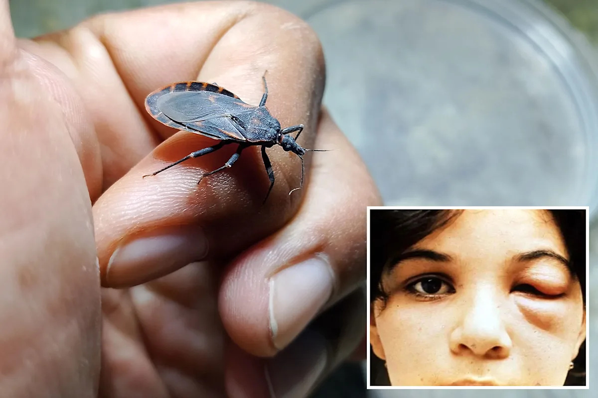 Case of deadly ‘kissing bug’ found in California — and sufferers may not even know they have it