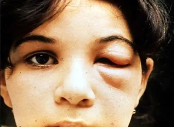 The deadly blood-sucking “kissing bug” has spread to Southern California. WHO/TDR Image Library
