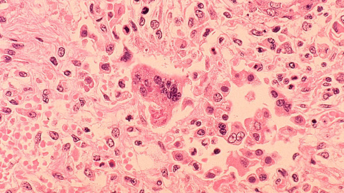 County health officials warn of possible measles exposure at LAX – NBC Los Angeles