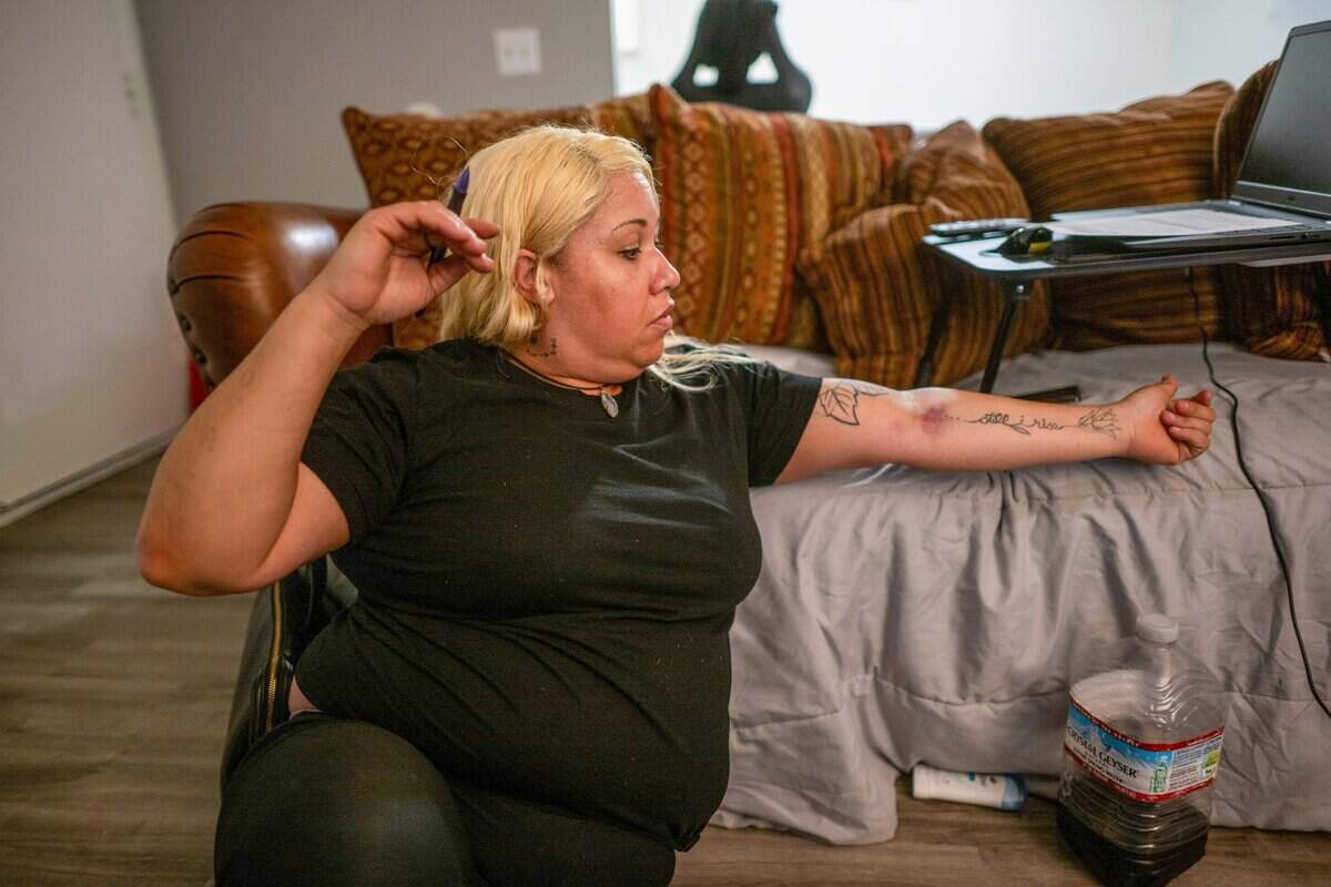Jocelyn Wright, 40, who said she fainted in a laundromat on June 7, shows a bruise on her arm where she had an IV was inserted at the hospital as she sits in her apartment in Rancho Cordova on June 9.