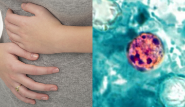 Cyclosporiasis: California now reporting cases of diarrheal illness