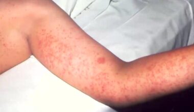 UC Davis doctor urges vaccinations as California measles cases double