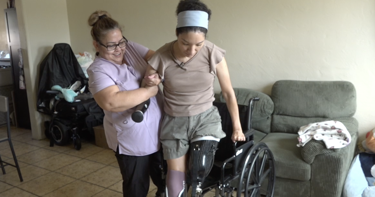 Logan Heights mom stands on prosthetic legs after flesh-eating disease battle