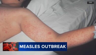 Measles exposure reported at Universal Studios Hollywood
