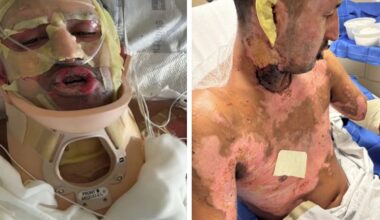 San Diego man sues Amazon over injuries from fire pit explosion