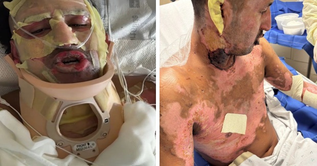 San Diego man sues Amazon over injuries from fire pit explosion