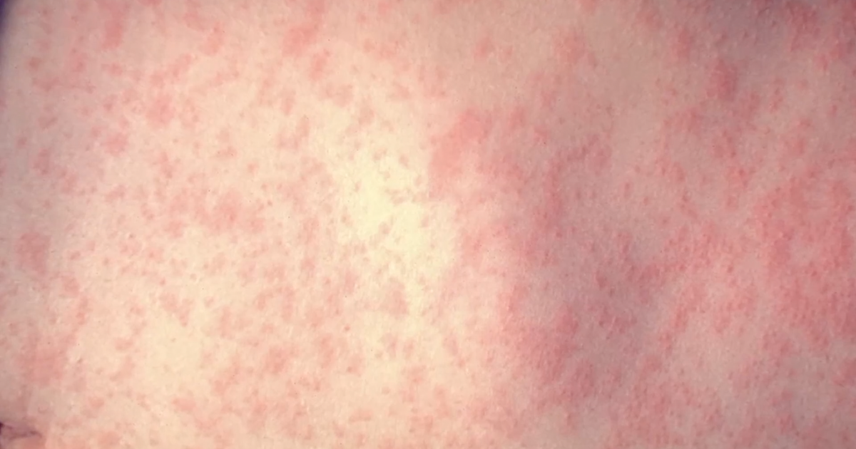 Kern County confirms first measles cases in residents since 2004