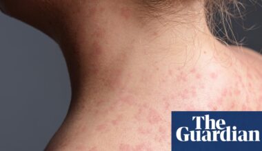 California warns of measles exposure in six counties from unvaccinated train passenger | California