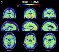 Three columns of three images each that are PET scans of brains. Each column contains three images of one brain.