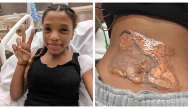 Teen Severely Burned During School Security Restraint