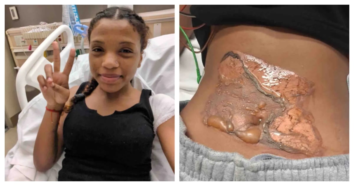 Teen Severely Burned During School Security Restraint