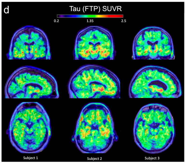 Three columns of three images each that are PET scans of brains.