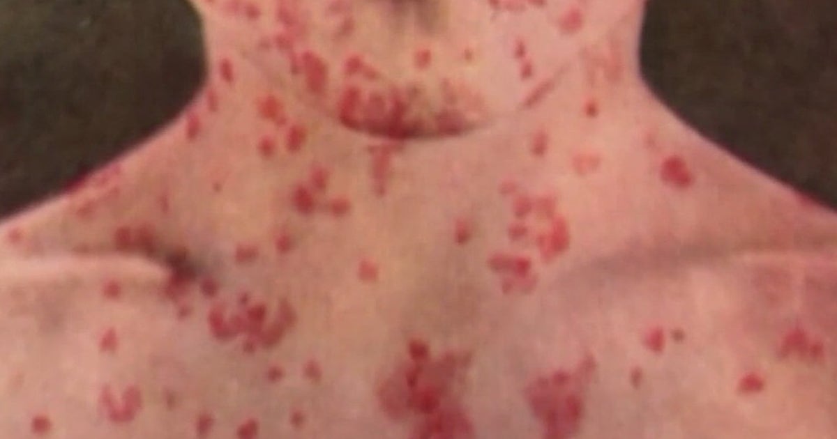 California health department notifies of measles exposure from unvaccinated Amtrak passenger