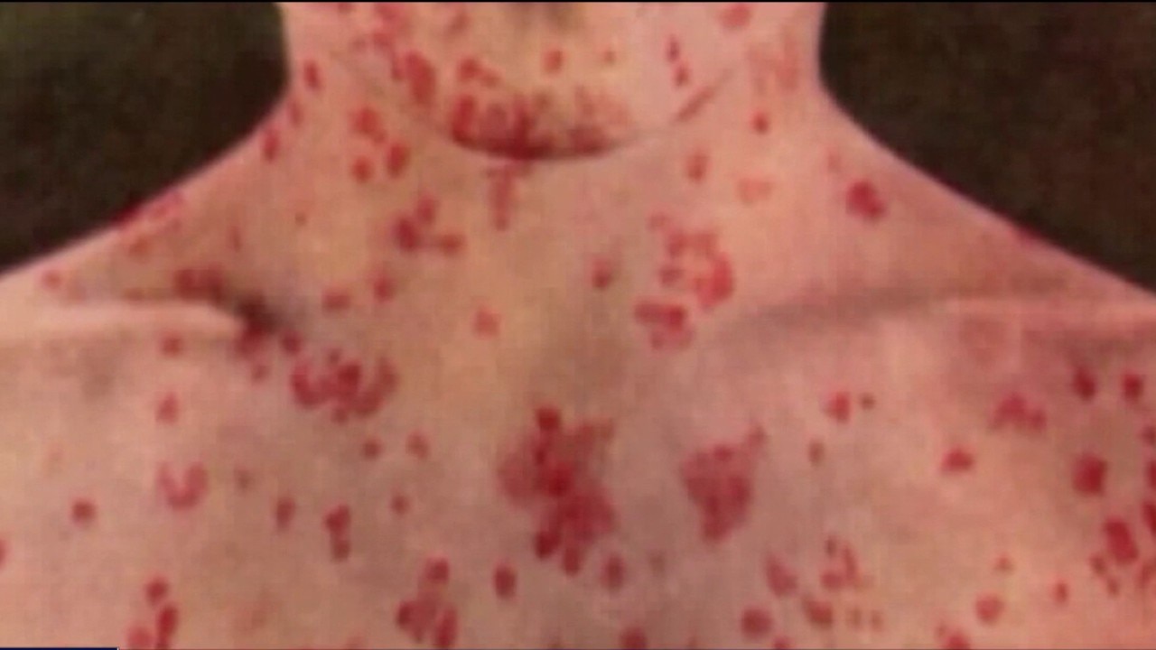 California health department notifies of measles exposure from unvaccinated Amtrak passenger
