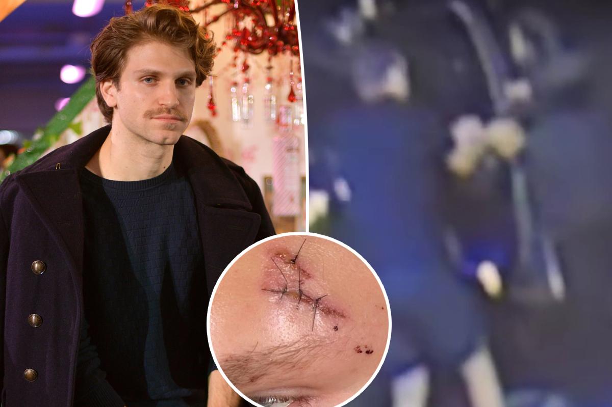 'Pretty Little Liars' star Keegan Allen reveals stitches following armed robbery in LA