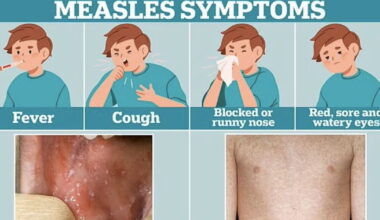 Dr Niranjan Dass urges children to get measles vax