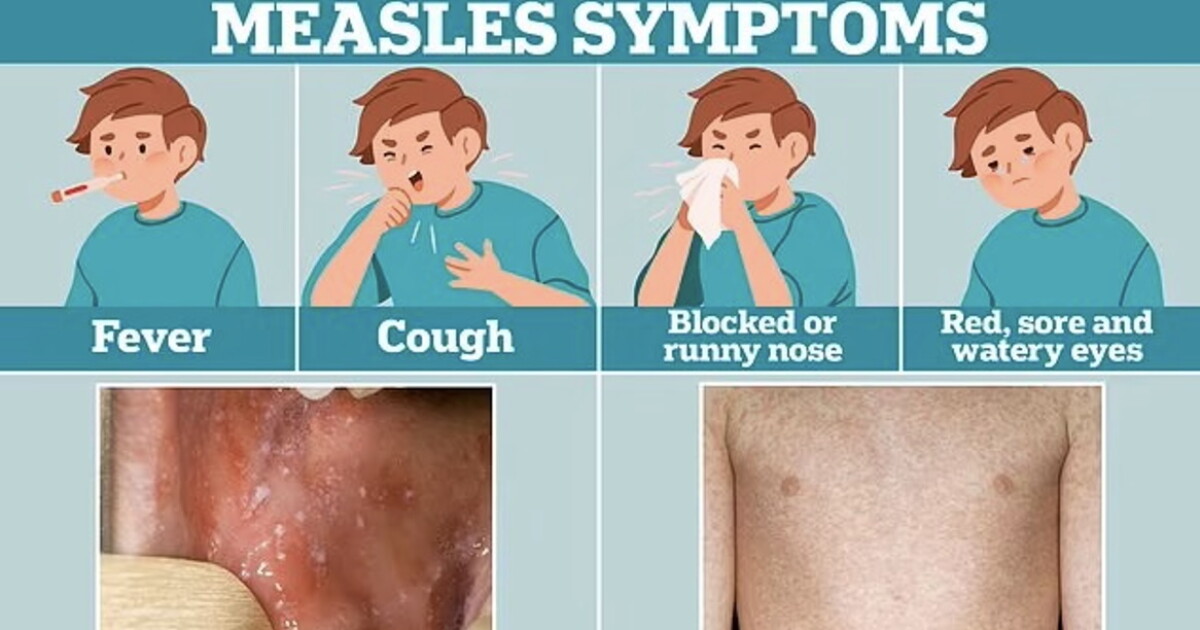 Dr Niranjan Dass urges children to get measles vax