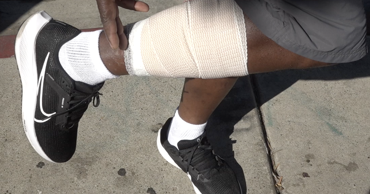 La Mesa handyman nearly loses leg to dog attack while helping homeless