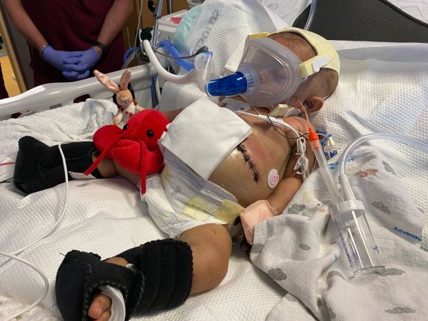 Mattie Beacham underwent a liver transplant at only nine months old. The procedure was successful, but she faces a lifetime of medical problems.