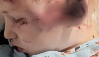 Family asks for help after 4-year-old boy loses his ear in Jacksonville dog attack