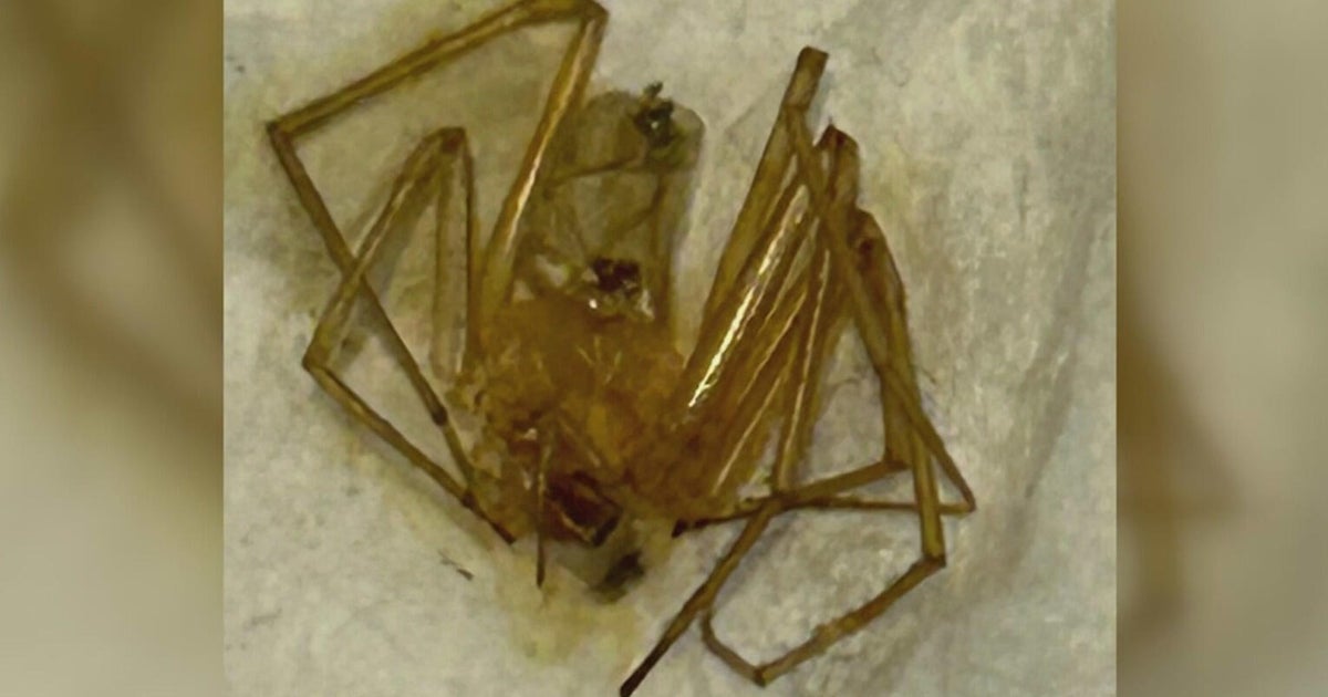 Florida woman says repeated spider bites inside her apartment led to toe amputation