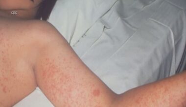 Florida sees spike in measles cases