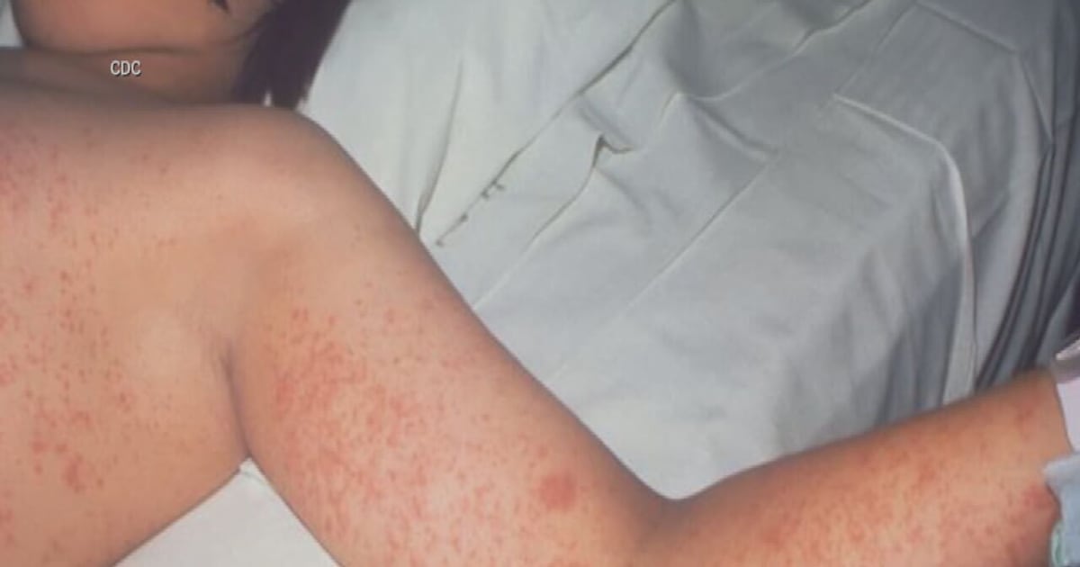 Florida sees spike in measles cases