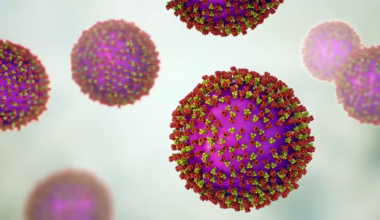 Measles case confirmed at St. Pete Catholic High School