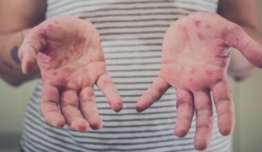 Florida measles cases: Doctors explain what it means for the community after confirming St. Pete case