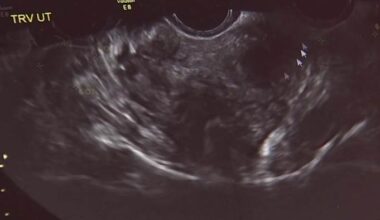 Proposed bill would fix issues to reestablish database for uterine fibroid research in Florida