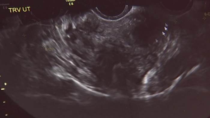 Proposed bill would fix issues to reestablish database for uterine fibroid research in Florida