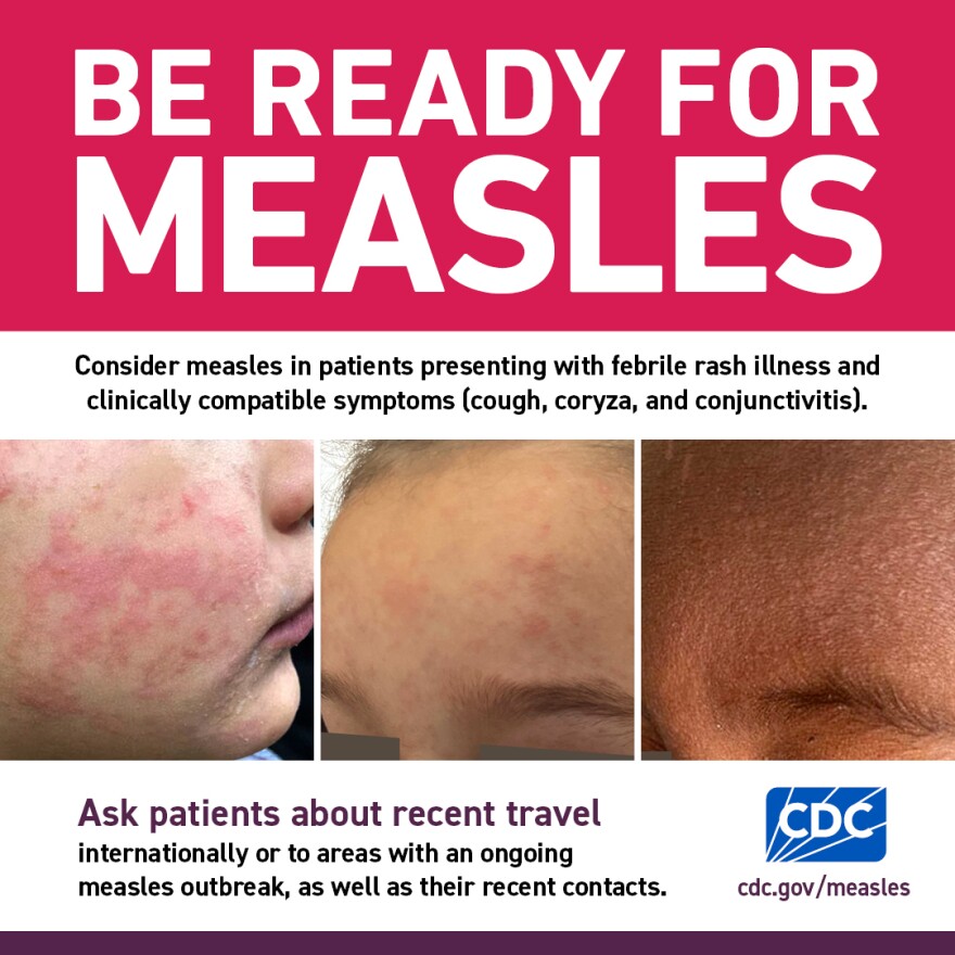 A positive test for measles has been reported by Lee Health in Lee County.