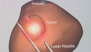 Local doctor explains new minimally invasive treatment for prostate cancer