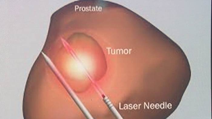 Local doctor explains new minimally invasive treatment for prostate cancer