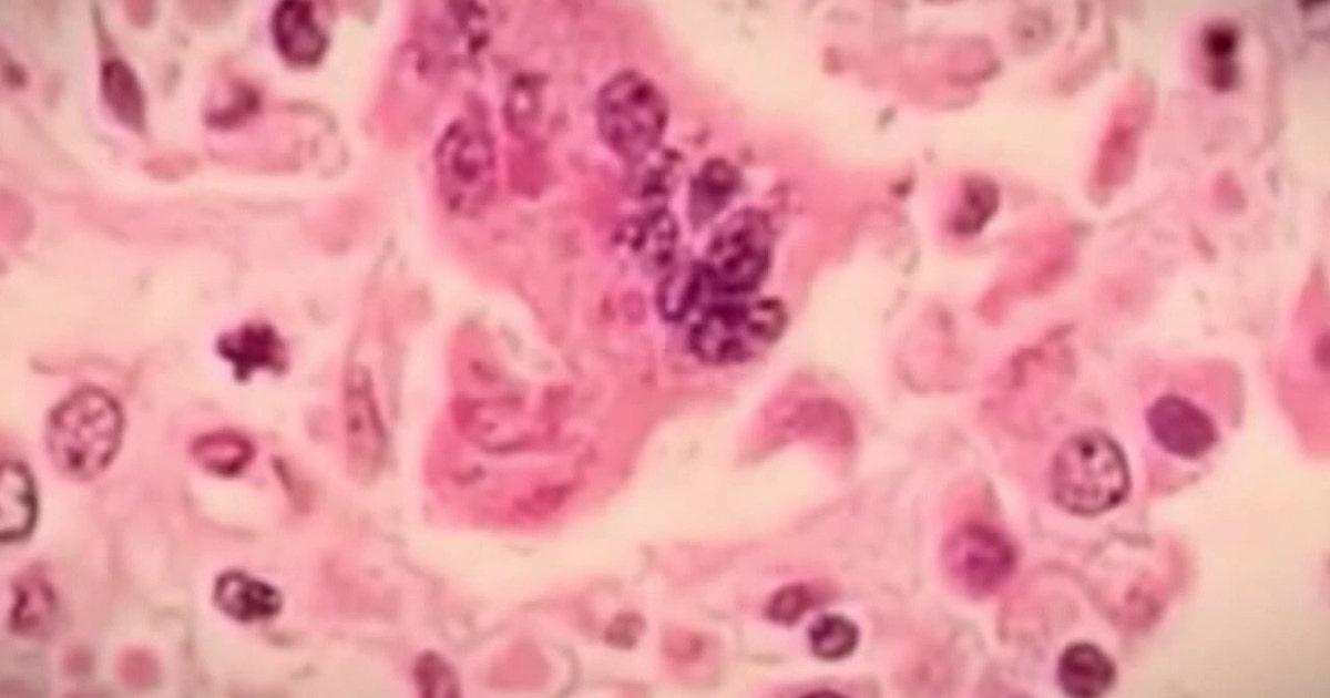 Florida has third-most measles cases in U.S.