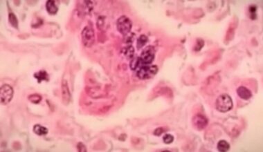 Florida measles cases surge, ranking third nationwide