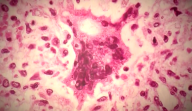 New measles data shows increase in cases across Southwest Florida, new age group impacted | State