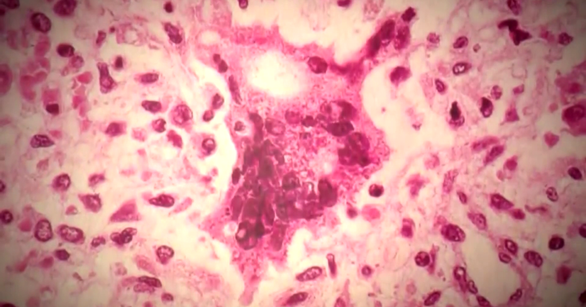 New measles data shows increase in cases across Southwest Florida, new age group impacted | State