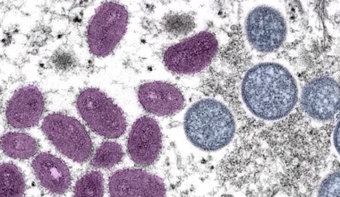 Monkey Pox case reported in Lee County | Investigations