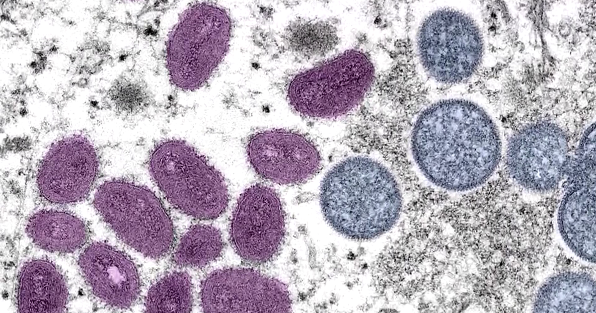 Monkey Pox case reported in Lee County | Investigations