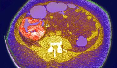 Bay Area doctors explain how to reduce colon cancer risk after James Van Der Beek’s death