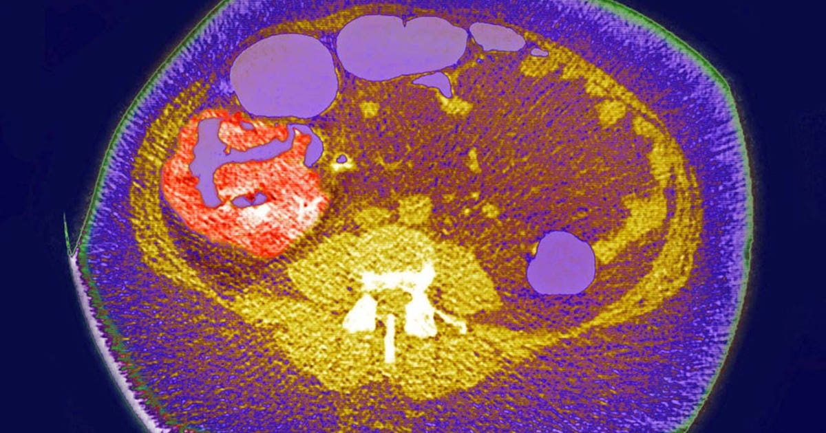 Bay Area doctors explain how to reduce colon cancer risk after James Van Der Beek’s death