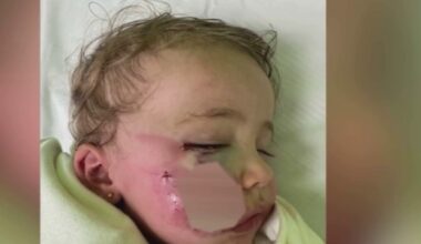 Father wants answers after 1-year-old daughter bitten in the face by dog in Miami Beach – NBC 6 South Florida