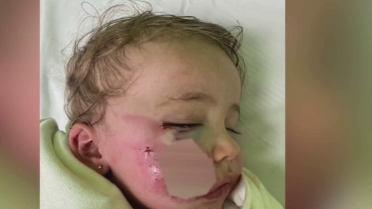 Father wants answers after 1-year-old daughter bitten in the face by dog in Miami Beach – NBC 6 South Florida