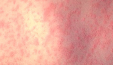 New case of measles reported at school in St. Petersburg